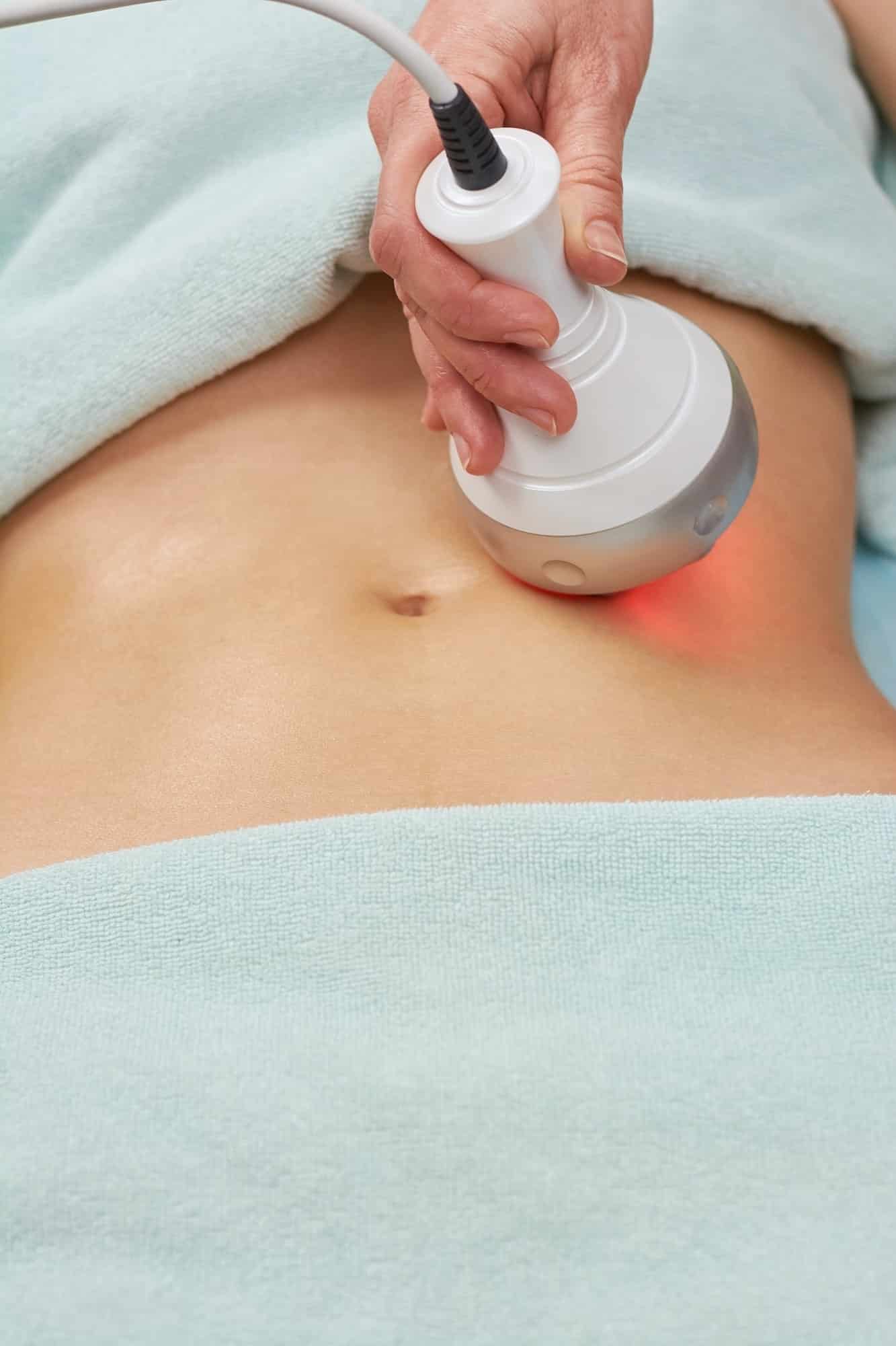 Rf skin tightening, female belly