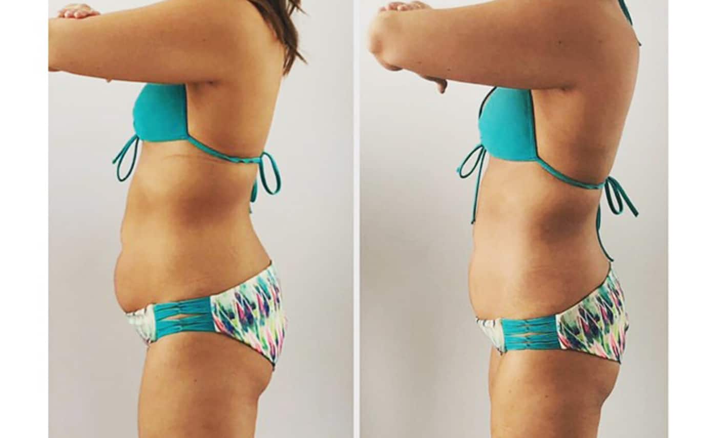 Slimwave-Electronic-Muscle-Stimulation-technology-montreal-before0and-after-1