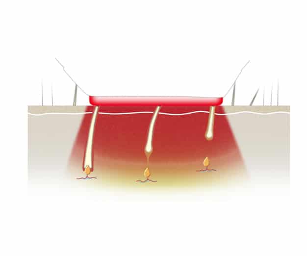 Illustrations d'explication du fonctionnement du traitement de photo-épilation par IPL sur la peau