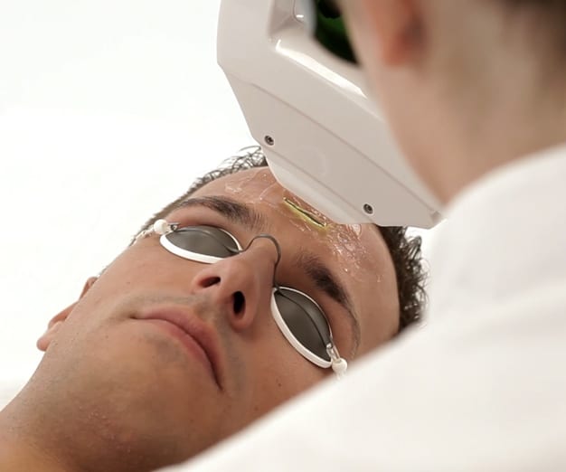 Traitement de photorajeunissement par IPL pour homme