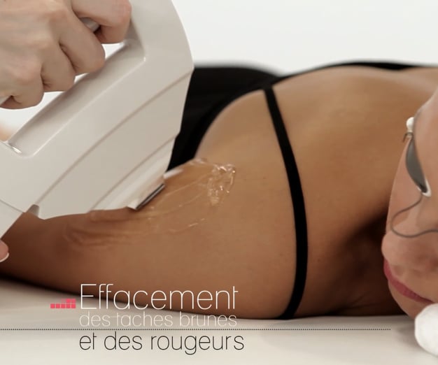Traitement de photorajeunissement des bras par IPL pour femmes