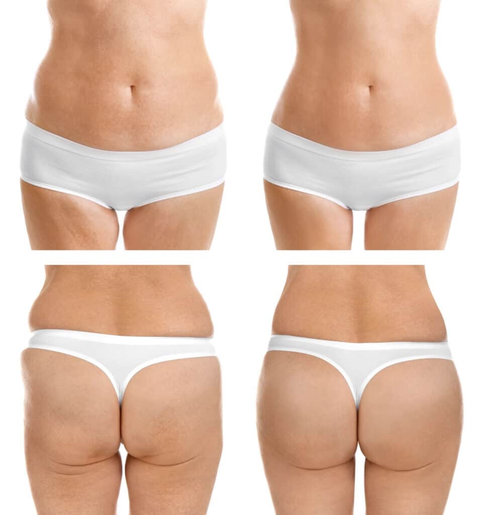 Slimwave-Electronic-Muscle-Stimulation-technology-montreal-before0and-after-2